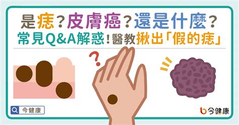 為甚麼會長痣|是痣？皮膚癌？還是什麼？常見Q&A解惑！醫教揪出「。